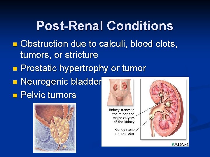 Post-Renal Conditions Obstruction due to calculi, blood clots, tumors, or stricture n Prostatic hypertrophy