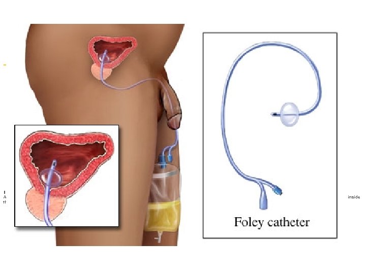 Last Updated: April 1, 2005 Foley catheter Illustration copyright 2004 Nucleus Communications, Inc. All