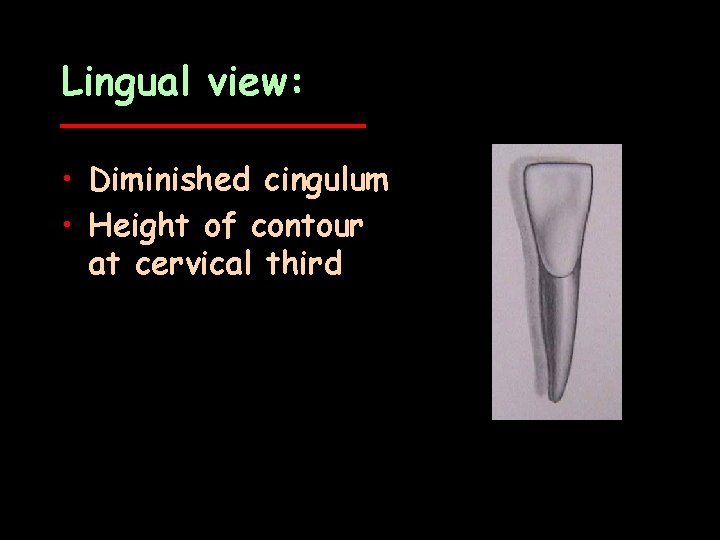 Lingual view: • Diminished cingulum • Height of contour at cervical third 