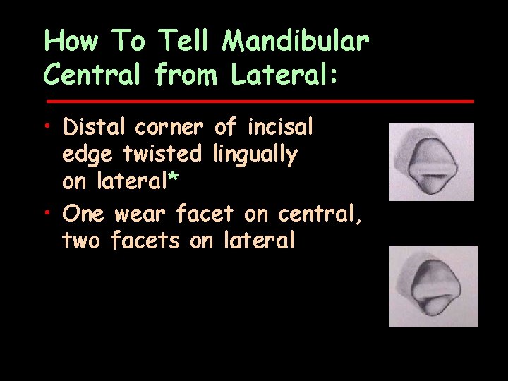 How To Tell Mandibular Central from Lateral: • Distal corner of incisal edge twisted