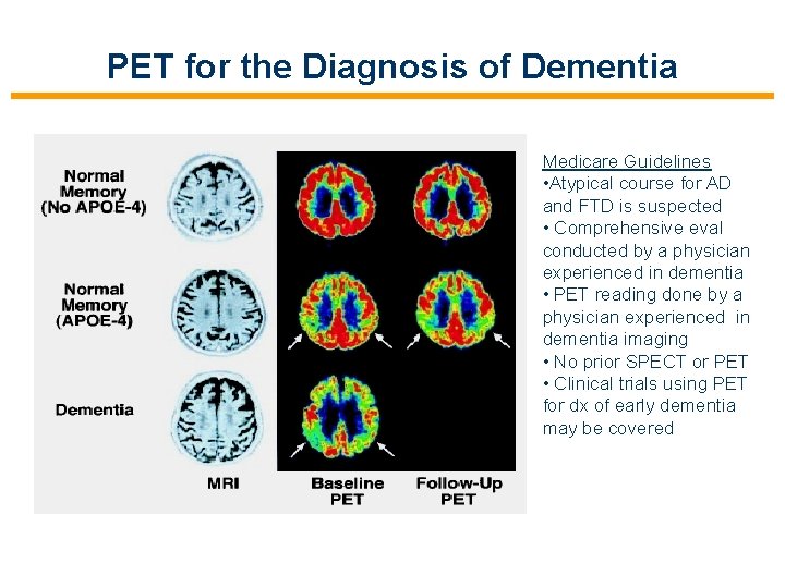 PET for the Diagnosis of Dementia Medicare Guidelines • Atypical course for AD and