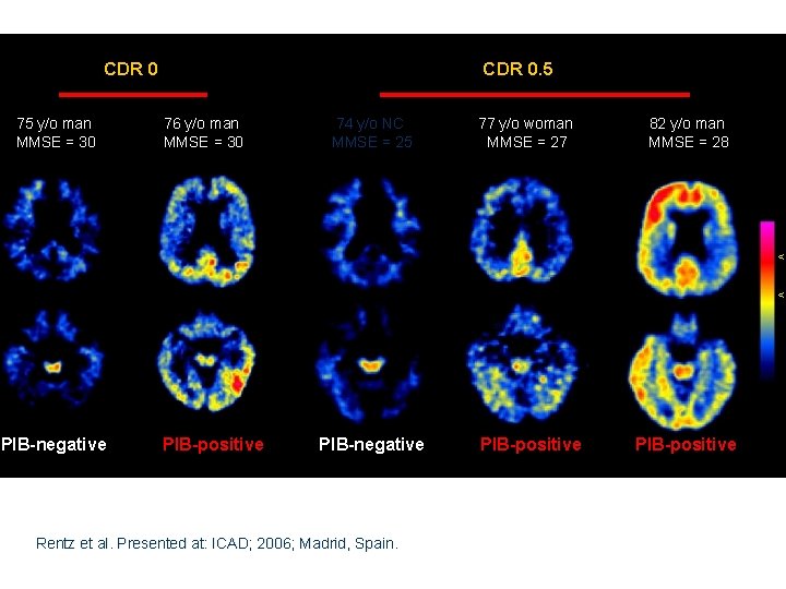 CDR 0 75 y/o man MMSE = 30 PIB-negative CDR 0. 5 76 y/o