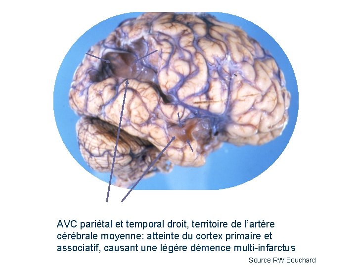 AVC pariétal et temporal droit, territoire de l’artère cérébrale moyenne: atteinte du cortex primaire