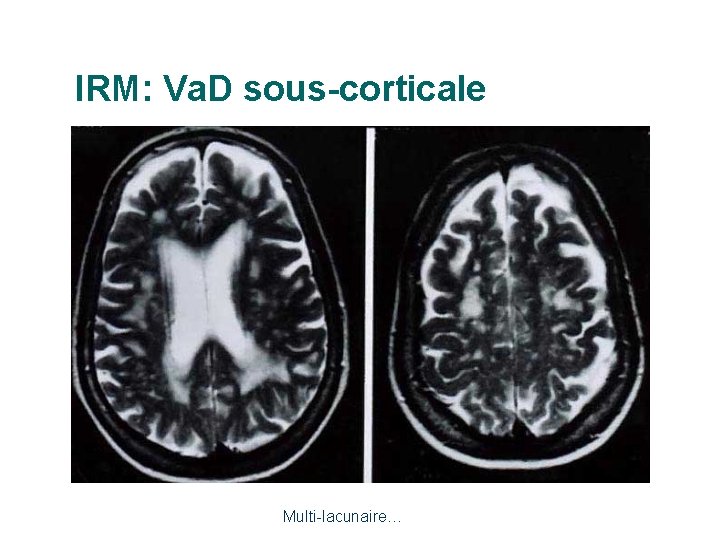 IRM: Va. D sous-corticale Multi-lacunaire… 
