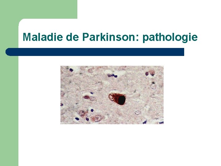 Maladie de Parkinson: pathologie 