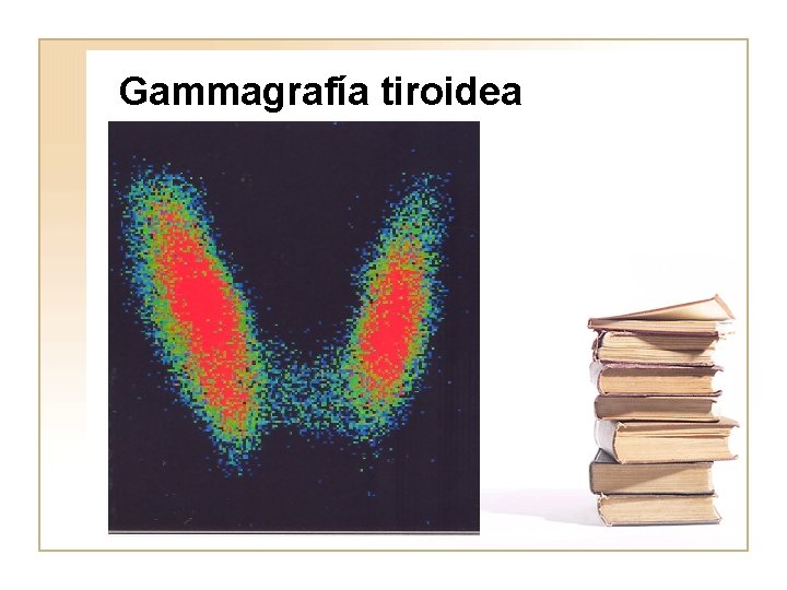 Gammagrafía tiroidea 