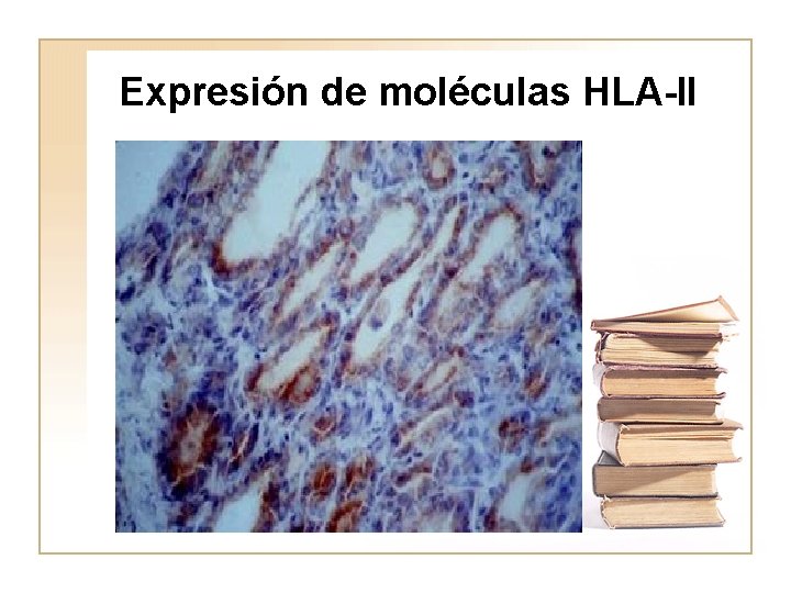 Expresión de moléculas HLA-II HLA class II expression in Graves' disease 