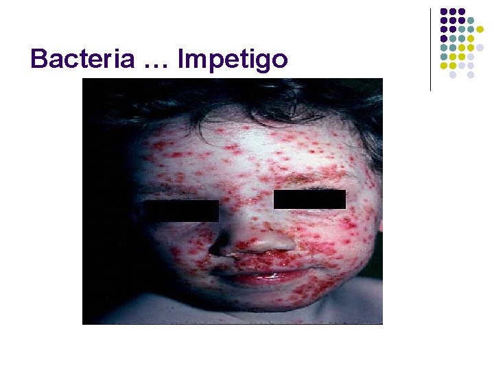 Bacteria … Impetigo 