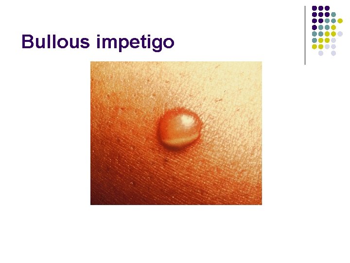 Bullous impetigo 