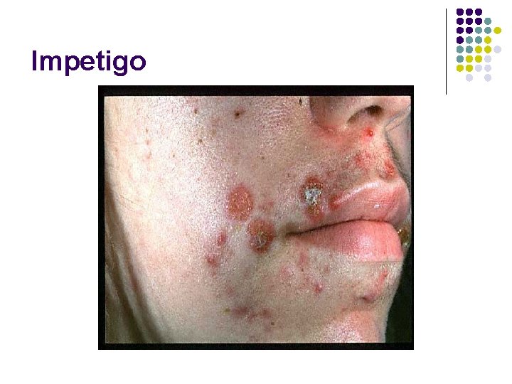 Impetigo 