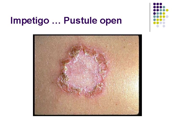 Impetigo … Pustule open 