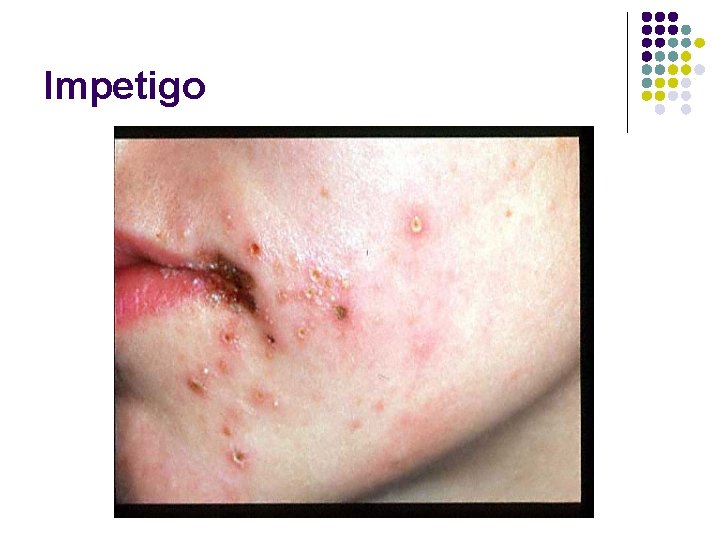 Impetigo 