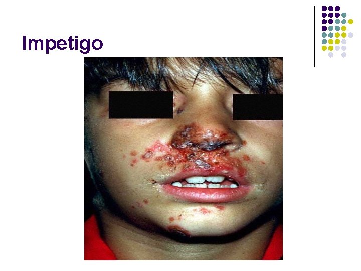 Impetigo 