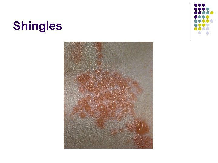 Shingles 