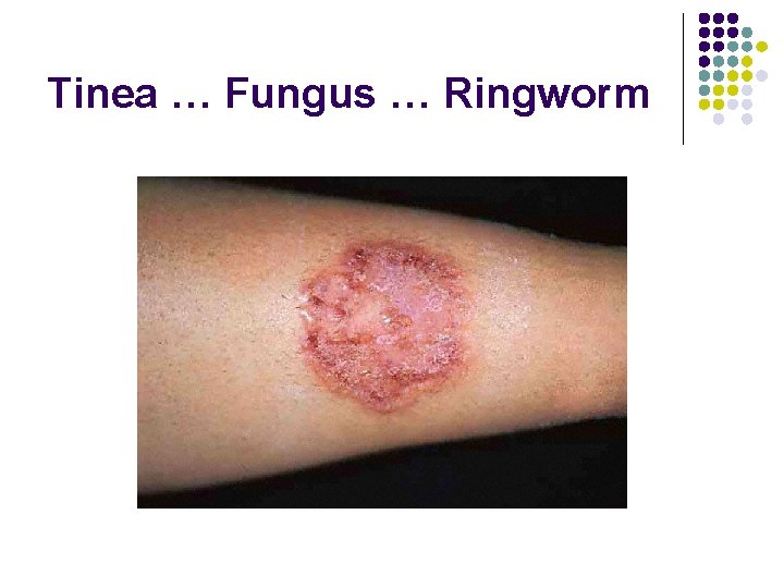 Tinea … Fungus … Ringworm 