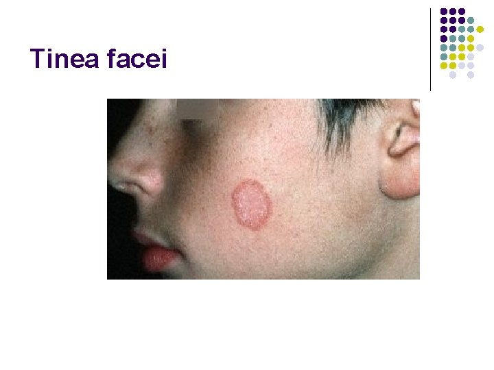 Tinea facei 