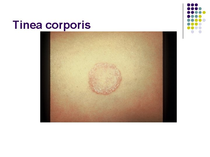 Tinea corporis 