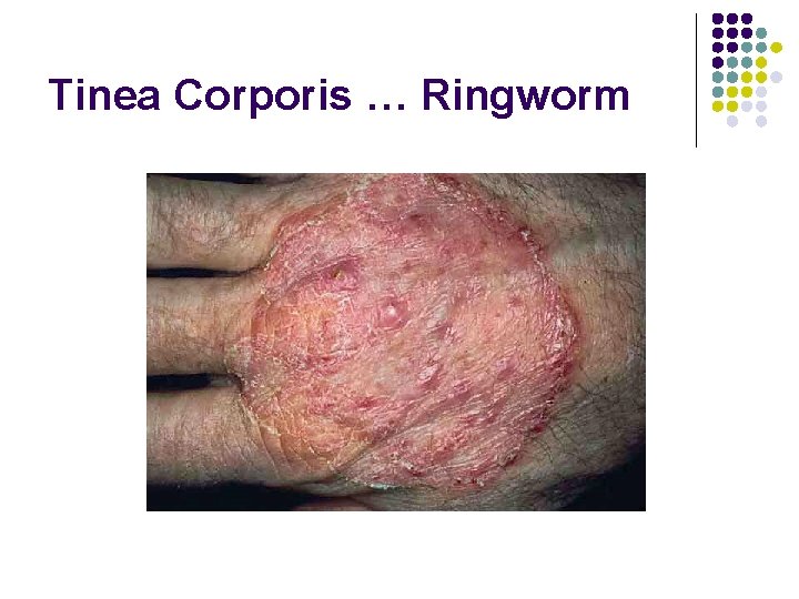 Tinea Corporis … Ringworm 