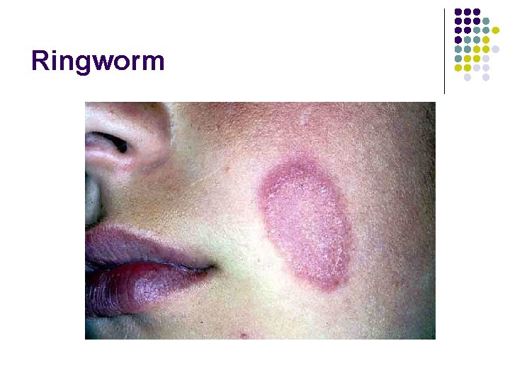 Ringworm 