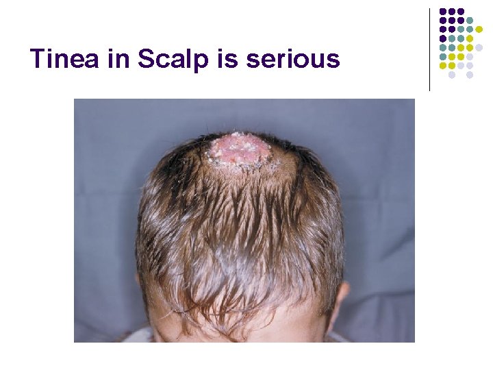 Tinea in Scalp is serious 