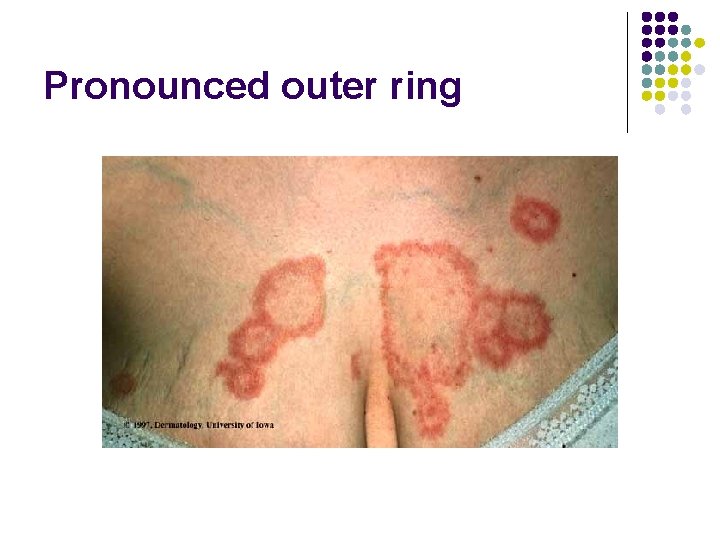 Pronounced outer ring 