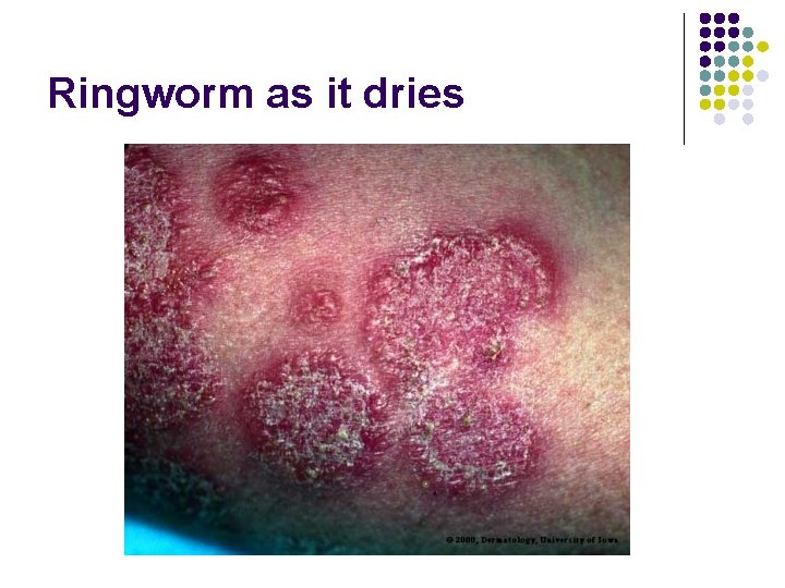 Ringworm as it dries 