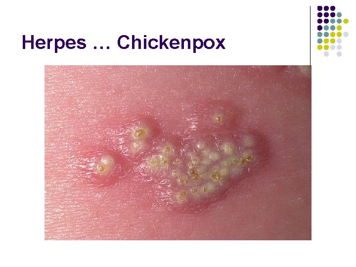 Herpes … Chickenpox 