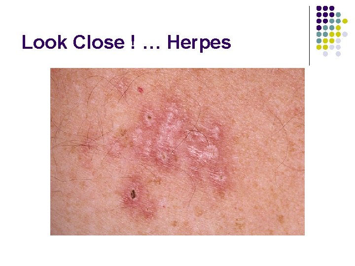Look Close ! … Herpes 
