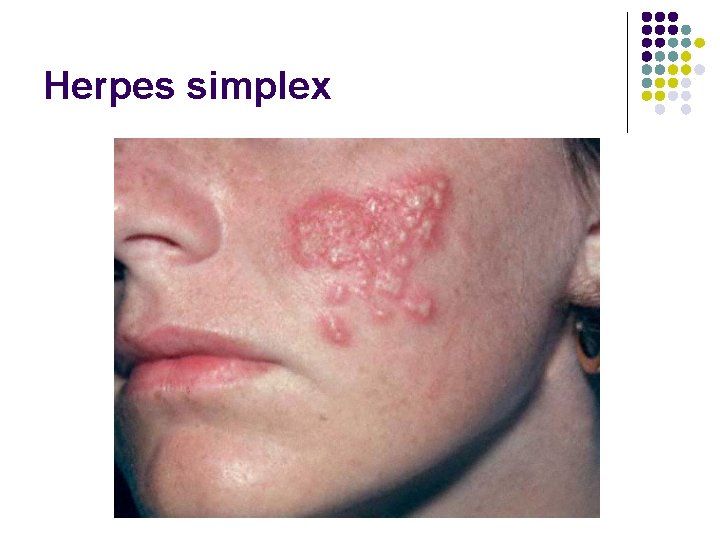 Herpes simplex 