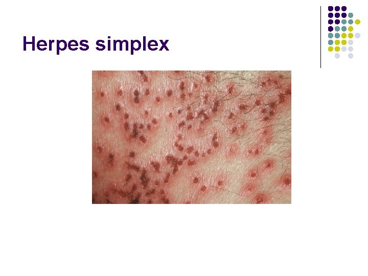 Herpes simplex 