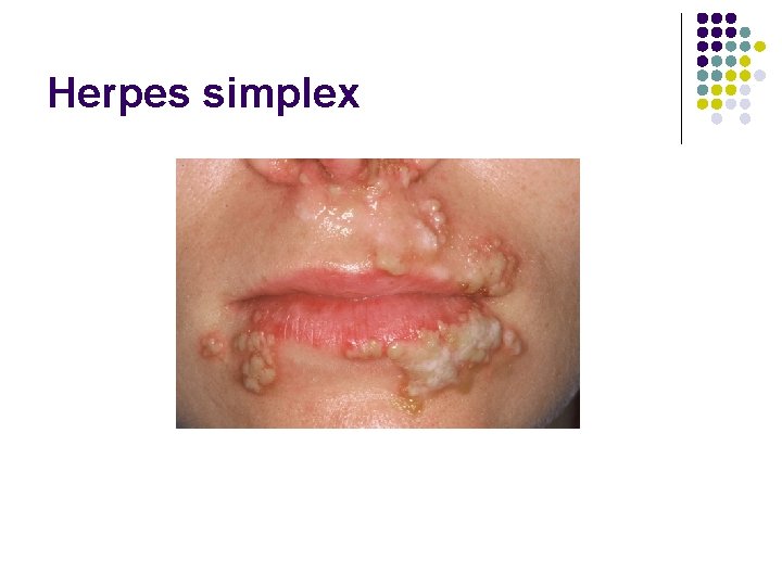 Herpes simplex 