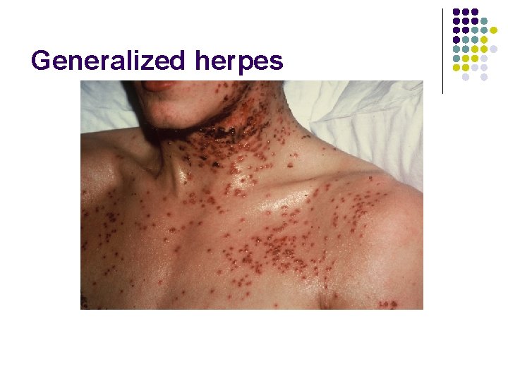 Generalized herpes 