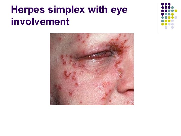 Herpes simplex with eye involvement 