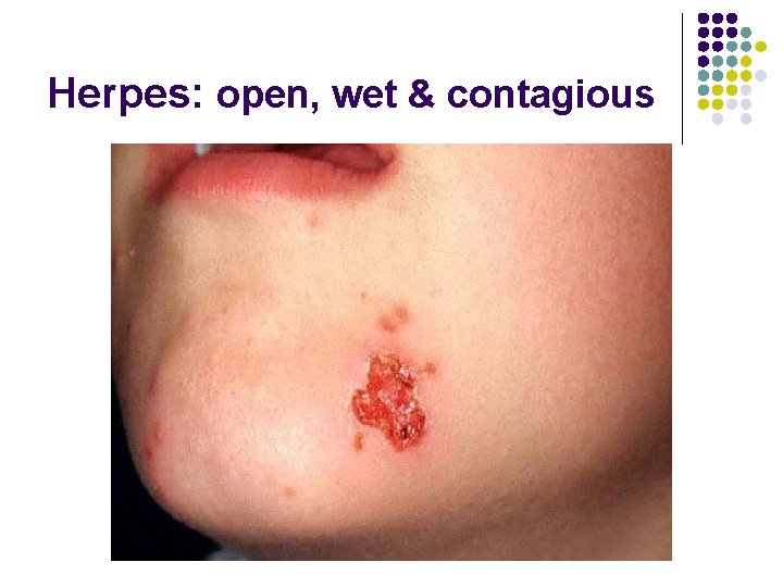 Herpes: open, wet & contagious 