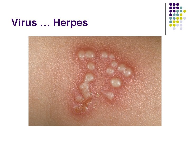 Virus … Herpes 