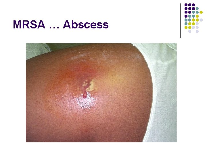 MRSA … Abscess 