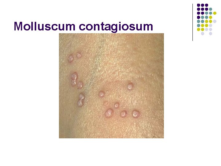 Molluscum contagiosum 