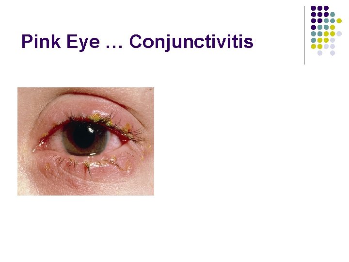 Pink Eye … Conjunctivitis 