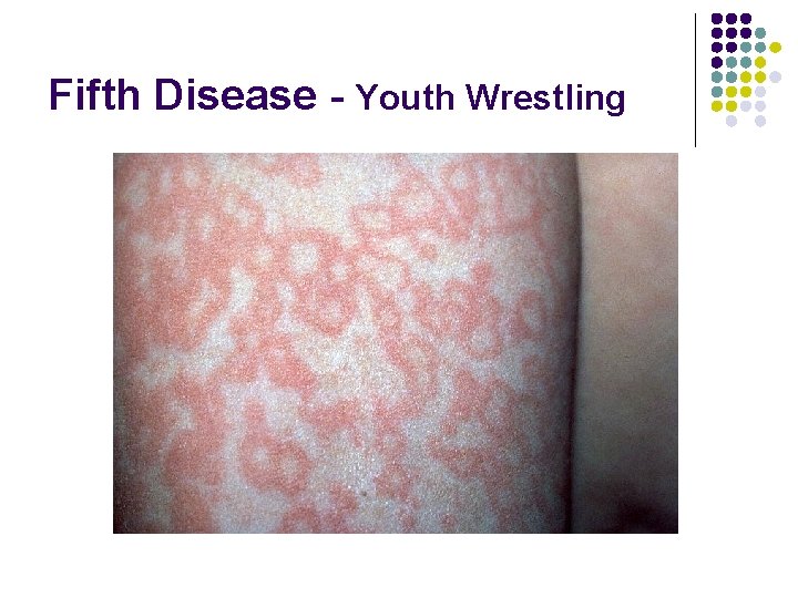 Fifth Disease - Youth Wrestling 
