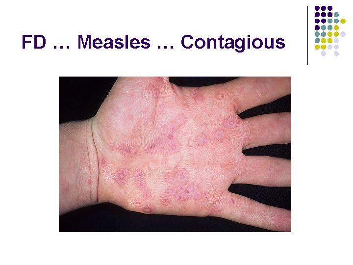 FD … Measles … Contagious 