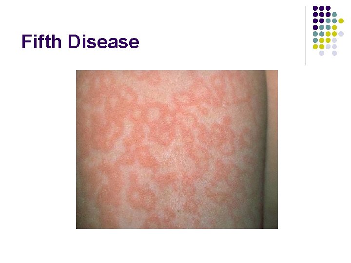 Fifth Disease 