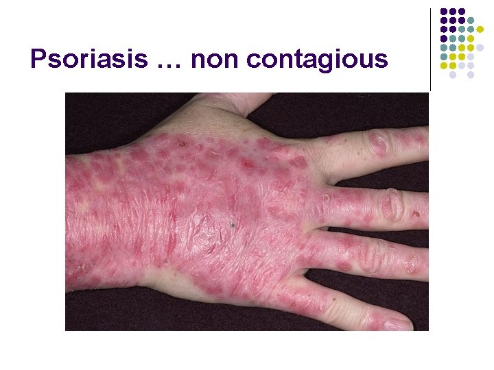 Psoriasis … non contagious 