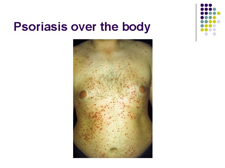 Psoriasis over the body 