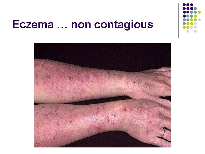 Eczema … non contagious 