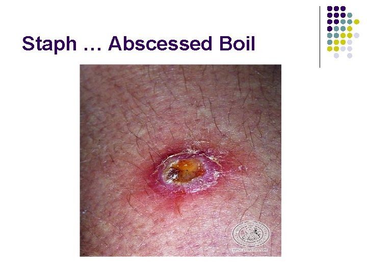 Staph … Abscessed Boil 