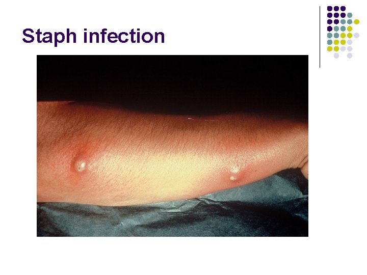 Staph infection 