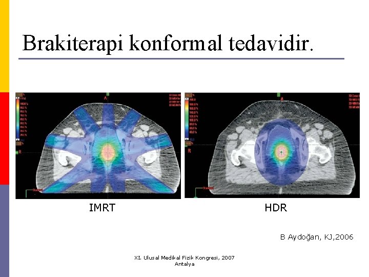 Brakiterapi konformal tedavidir. IMRT HDR B Aydoğan, KJ, 2006 XI. Ulusal Medikal Fizik Kongresi,