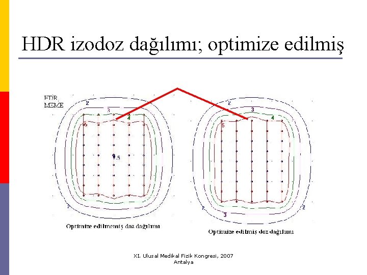 HDR izodoz dağılımı; optimize edilmiş XI. Ulusal Medikal Fizik Kongresi, 2007 Antalya 