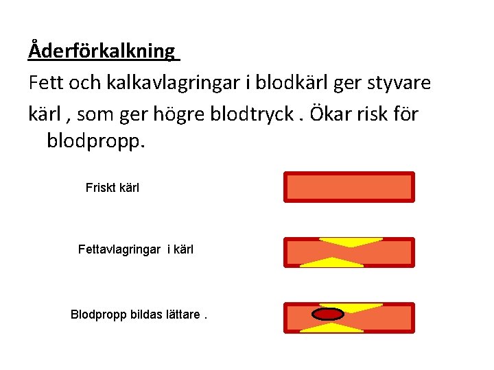 Åderförkalkning Fett och kalkavlagringar i blodkärl ger styvare kärl , som ger högre blodtryck.