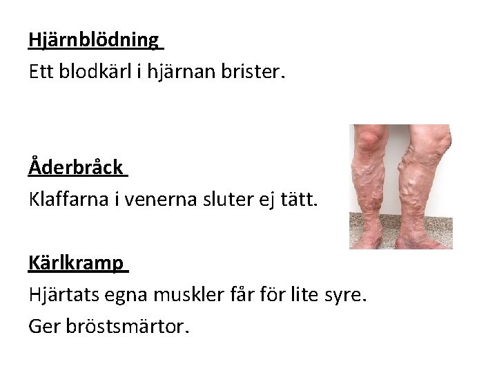 Hjärnblödning Ett blodkärl i hjärnan brister. Åderbråck Klaffarna i venerna sluter ej tätt. Kärlkramp